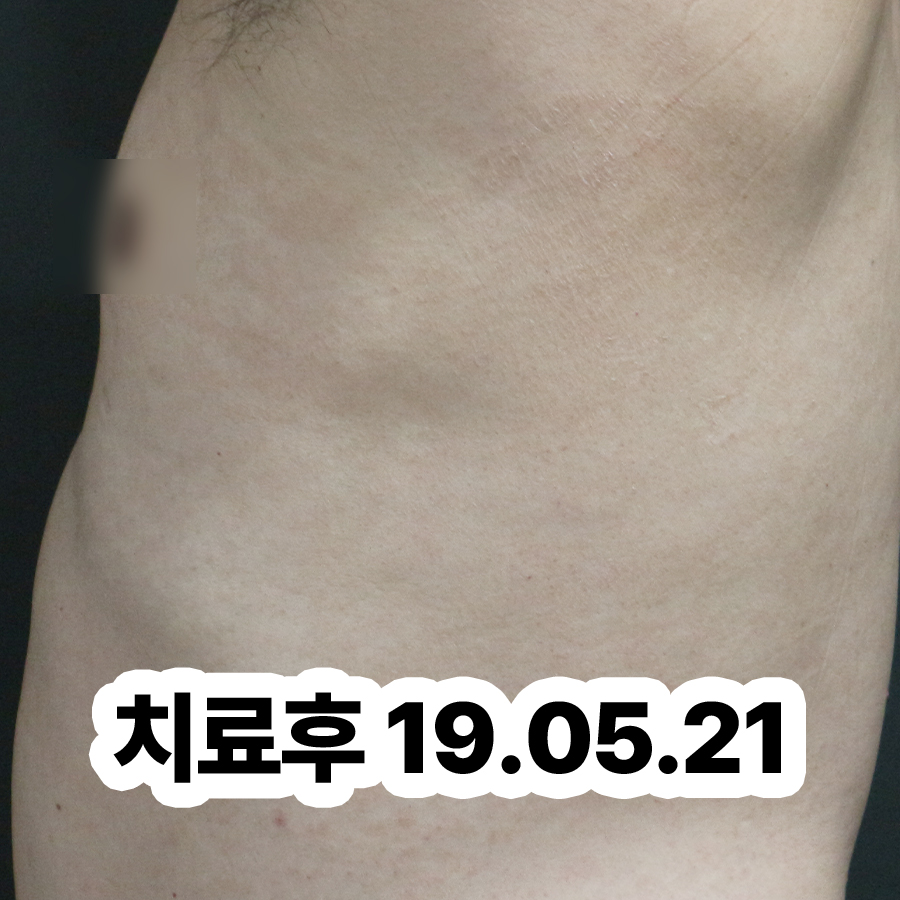 불당 건선 피부염 원인 관련 이미지 3