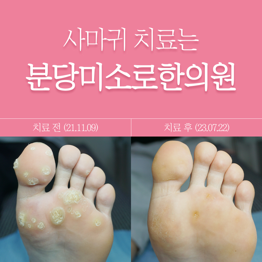 용인 한의원 사마귀 치료 비용 관련 이미지 1
