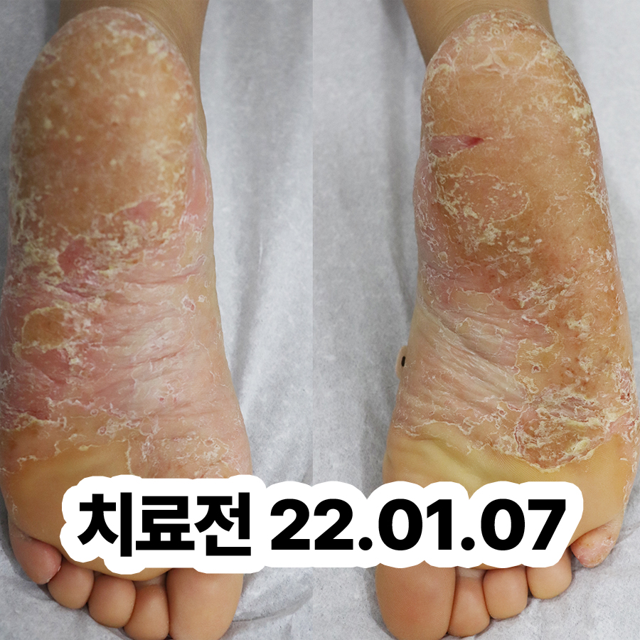 분당 두피건선 치료제 관련 이미지 2
