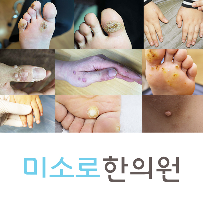 성남 사마귀면역치료 후기 관련 이미지 1