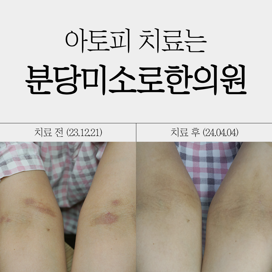 판교 성인아토피한의원 관련 이미지 1