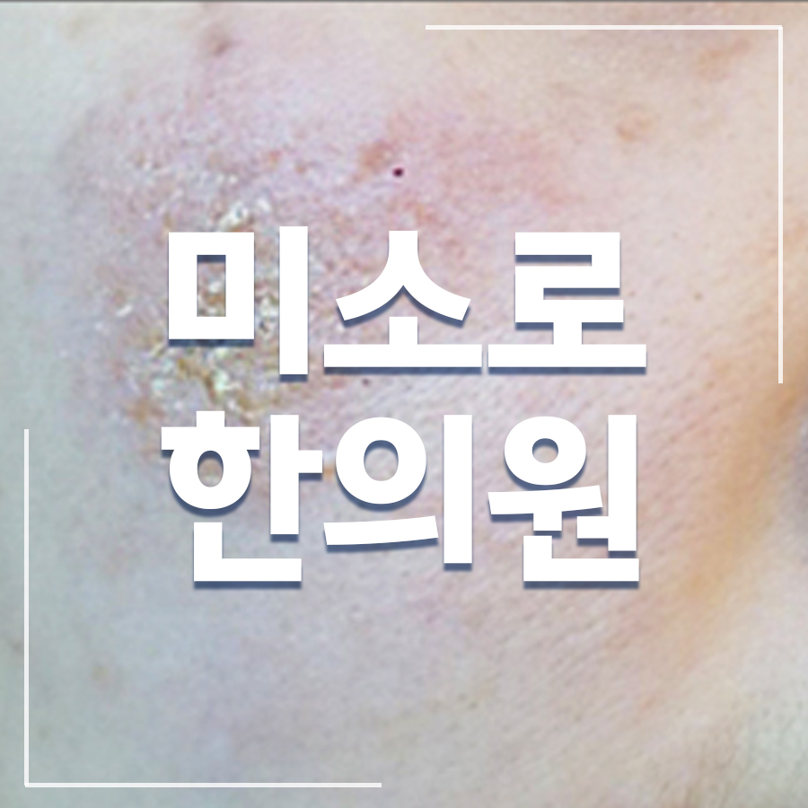분당 습진 보습제 추천 관련 이미지 1