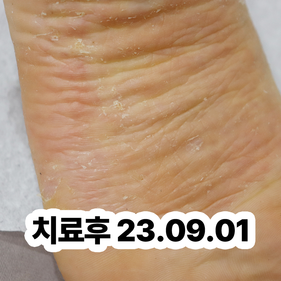 경기광주 발가락 한포진 연고 관련 이미지 3
