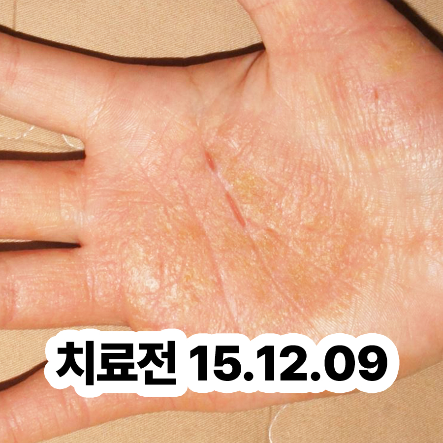 분당 한포진 피부과 추천 관련 이미지 2