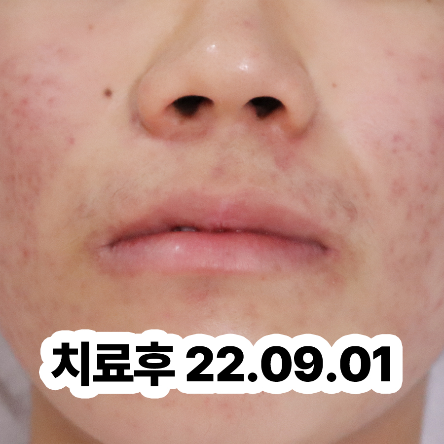 이천 얼굴 지루성 피부염 원인 관련 이미지 3