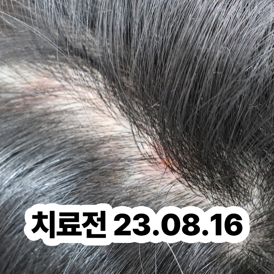성남 두피지루성피부염피부과 관련 이미지 2