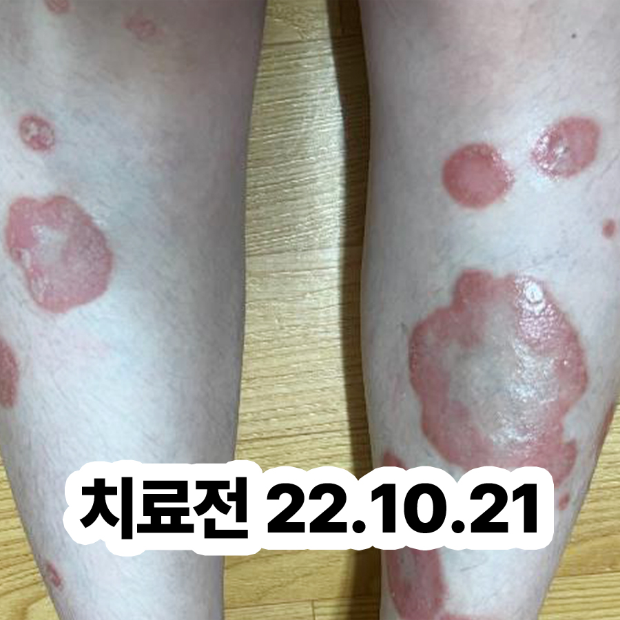 용인 건선 보습제 추천 관련 이미지 2