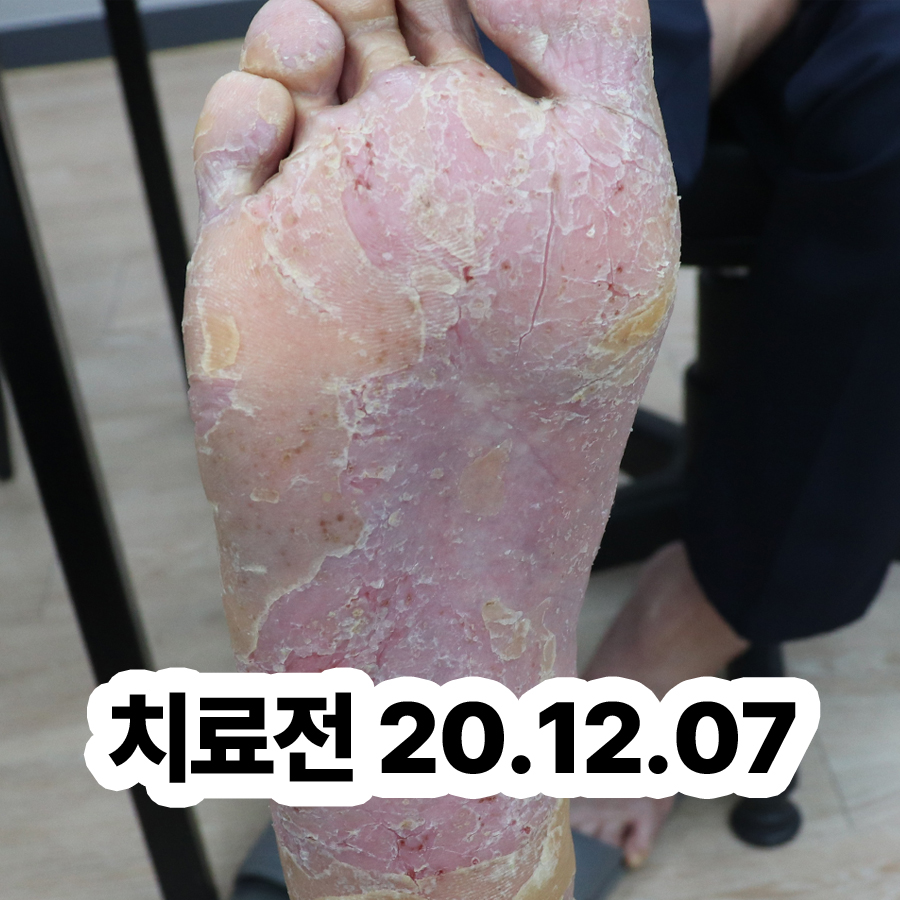 분당 피부건선치료법 관련 이미지 2