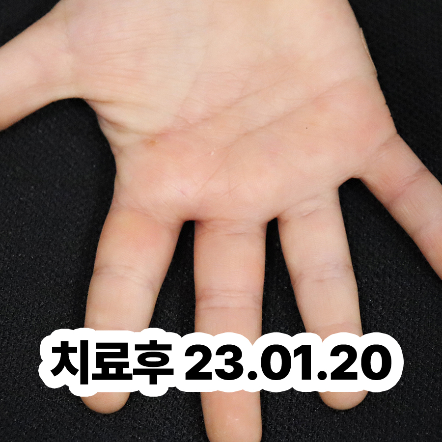 이천 손 한포진 물집 관련 이미지 3