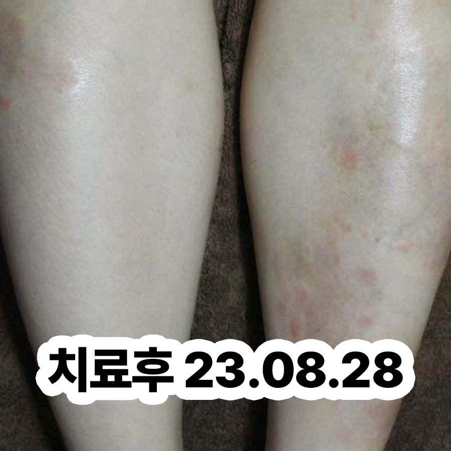 용인 건선 보습제 추천 관련 이미지 3