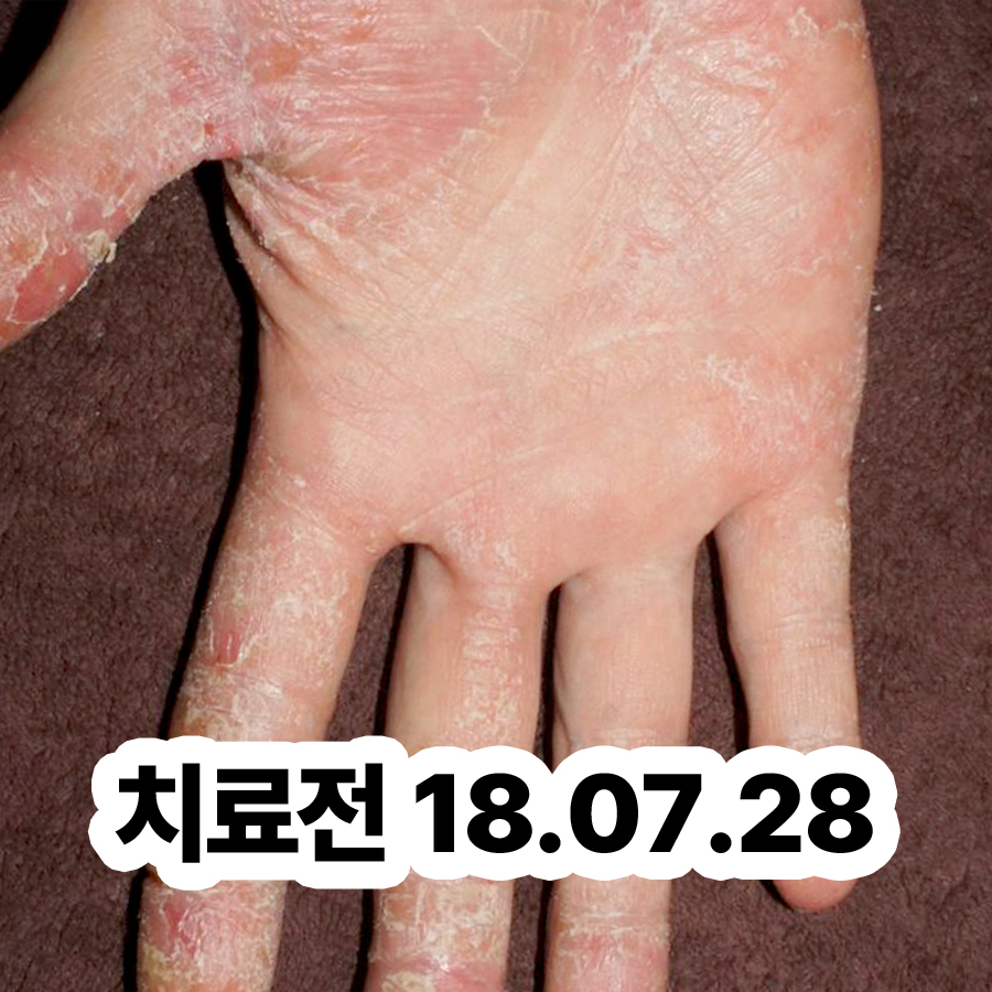 분당 한포진 약 관련 이미지 2