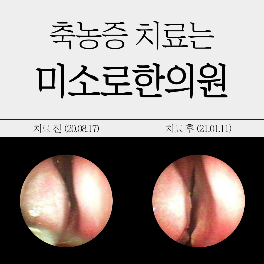 판교 부비동염 수술후 코세척 방법 관련 이미지 1
