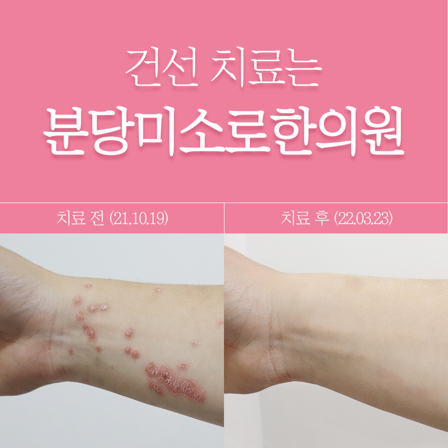 분당 건선피부치료 관련 이미지 1