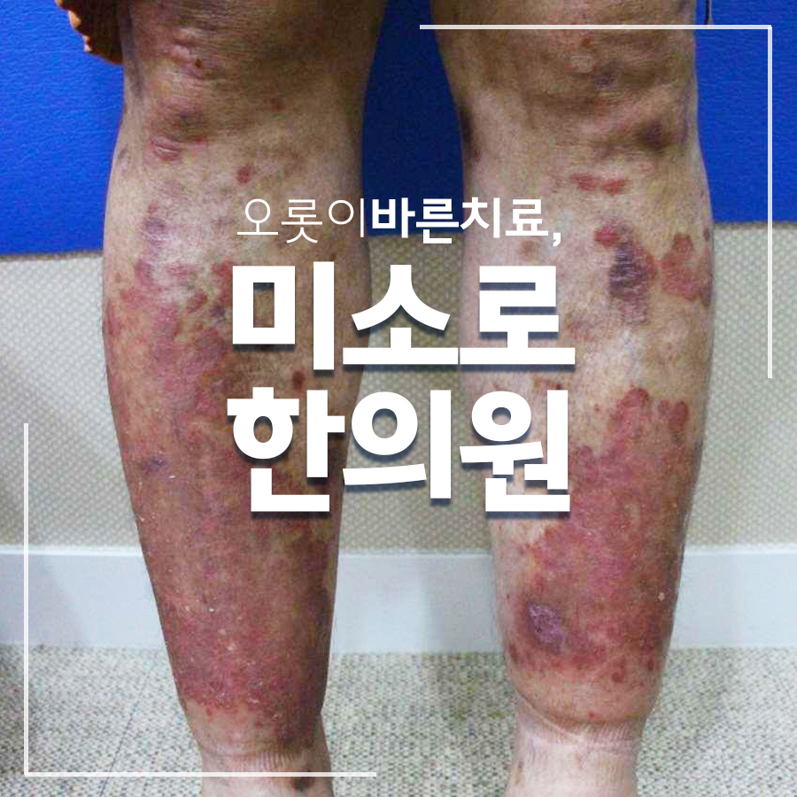 분당 건선피부치료 관련 이미지 1