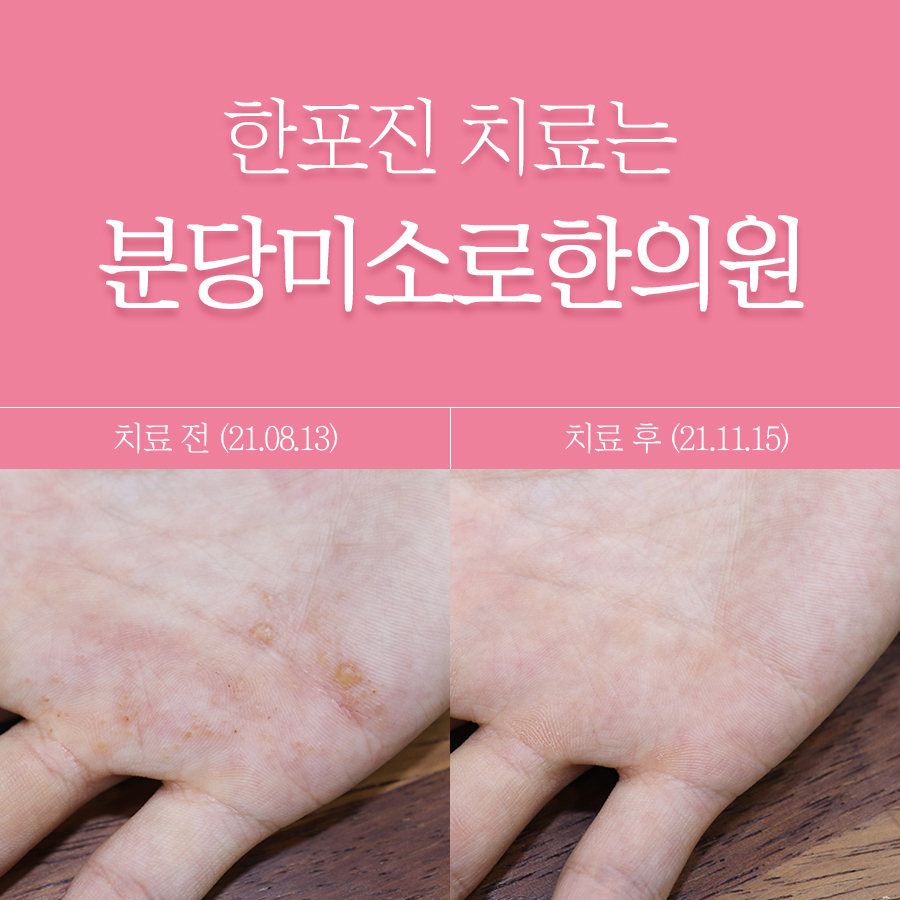 분당 한포진 치료 관련 이미지 1