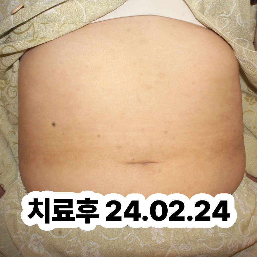 분당 건선피부치료 관련 이미지 3