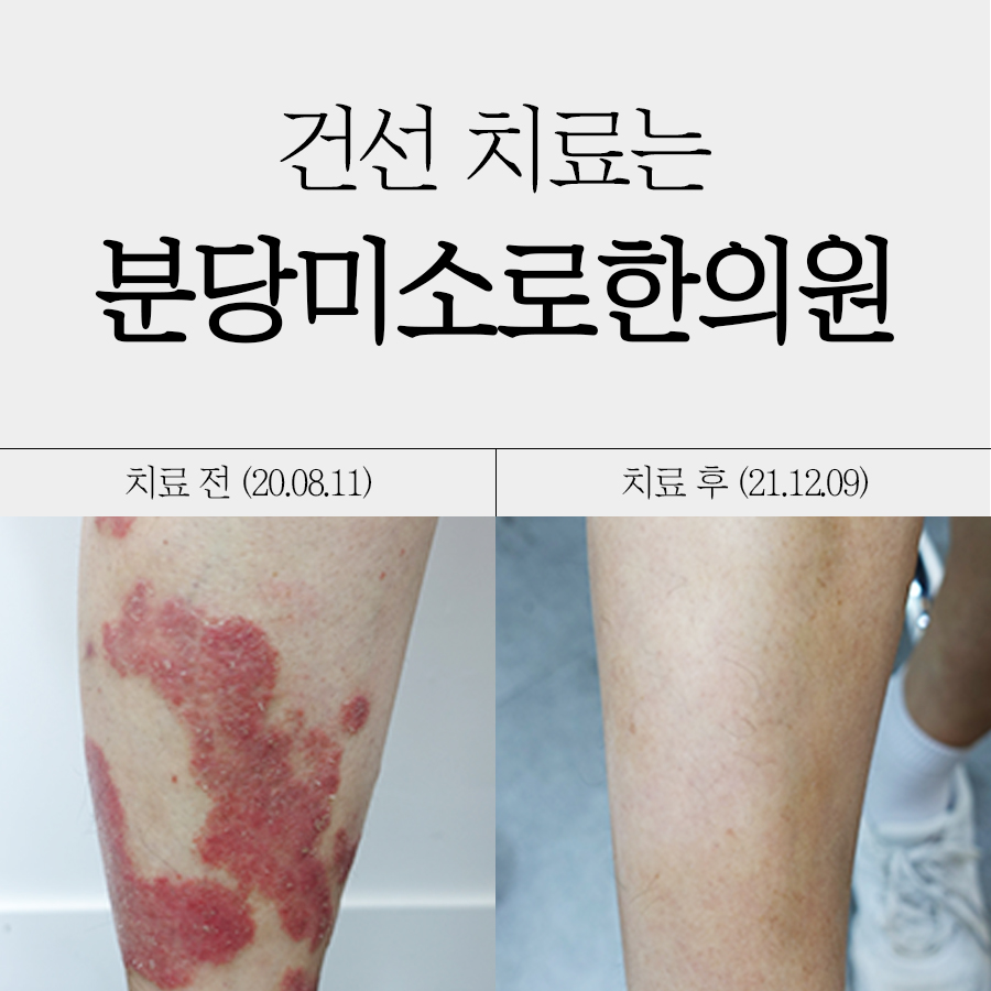 용인 건선엑시머레이저 관련 이미지 1