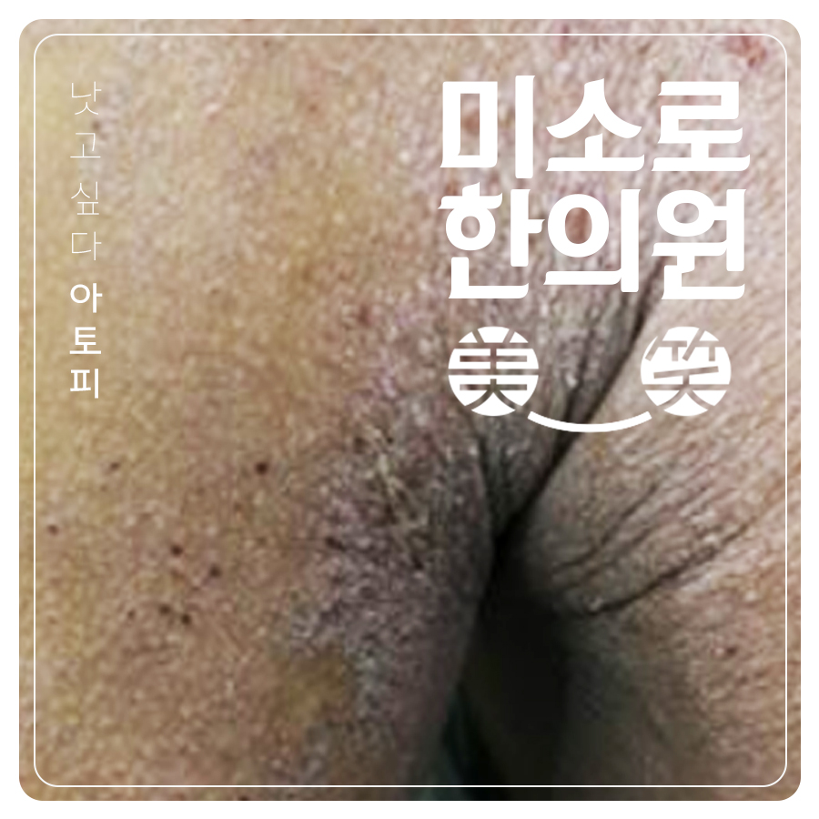 용인 성인아토피치료방법 관련 이미지 1