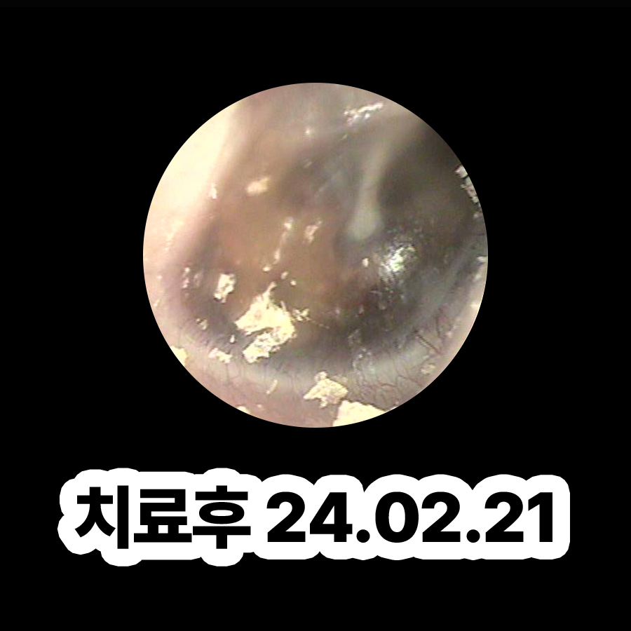 판교 중이염 약국약 관련 이미지 3
