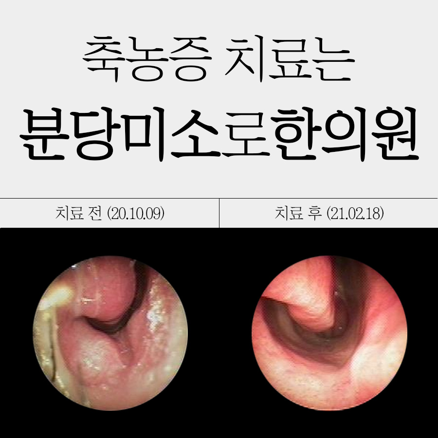 경기광주 급성 부비동염 증상 관련 이미지 1