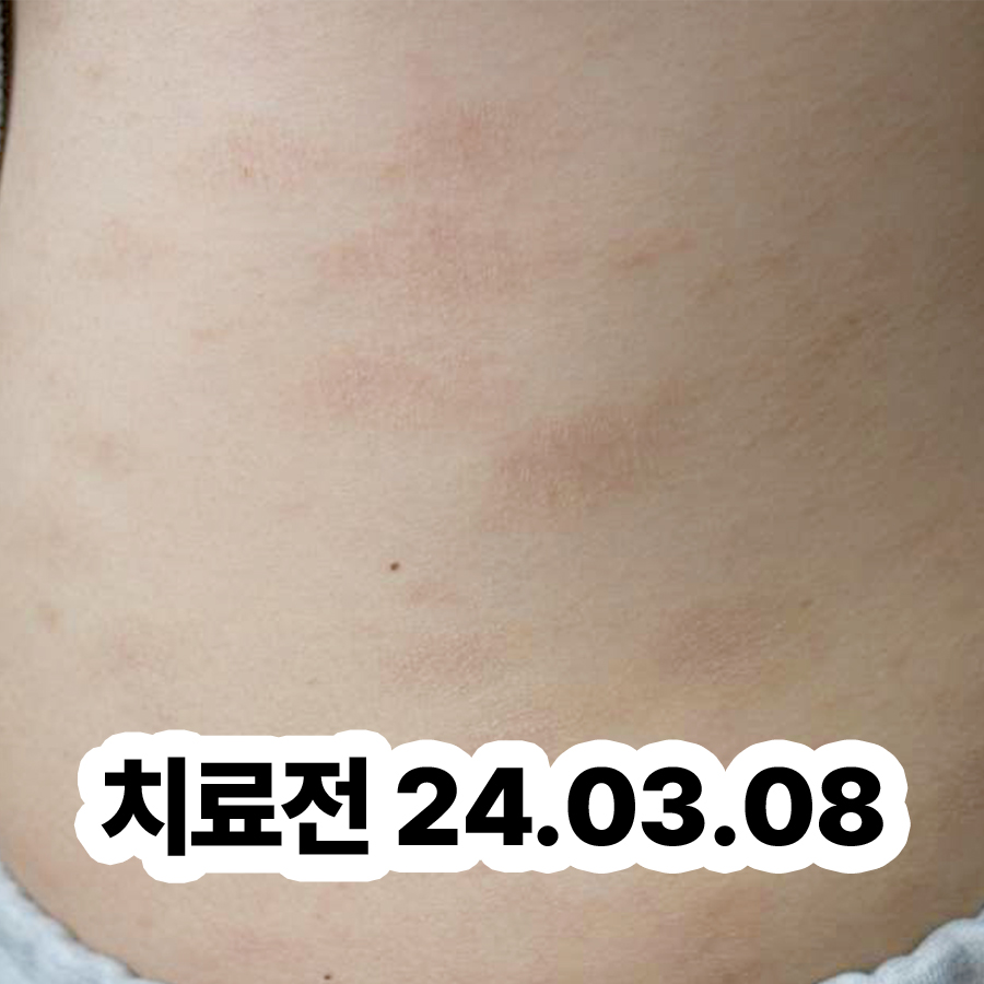 분당 두드러기치료방법 관련 이미지 2