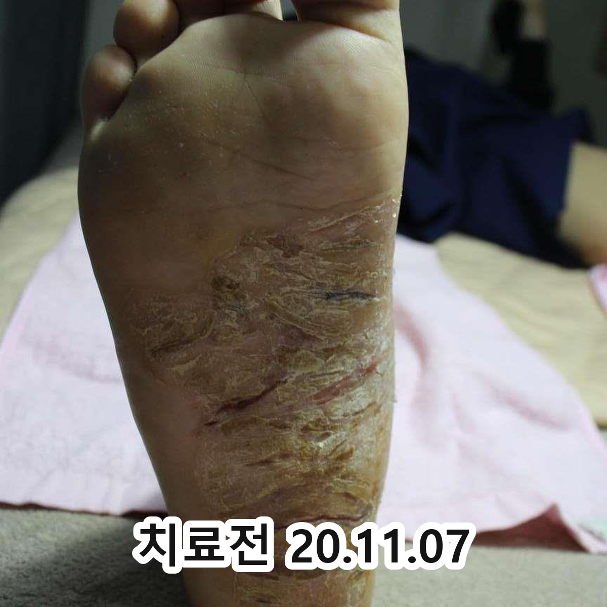 봉동 화폐상습진 연고 관련 이미지 2