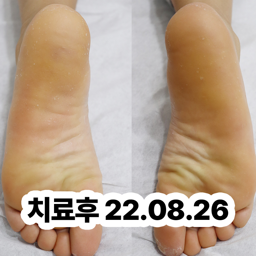 분당 두피건선 치료제 관련 이미지 3