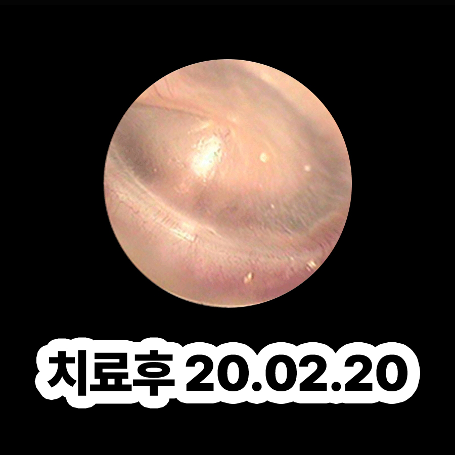 분당 중이염 약 안 먹고 관련 이미지 3