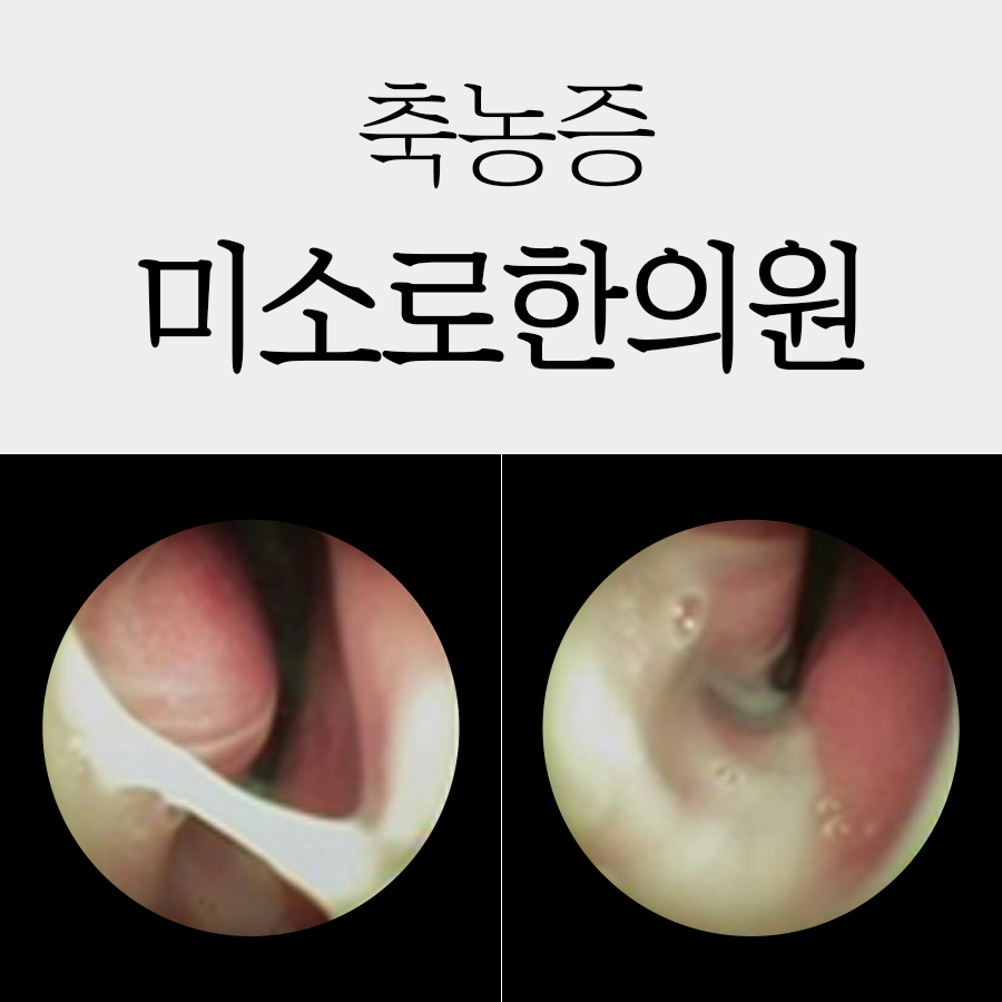여주 만성 부비동염 완치 기간 관련 이미지 1