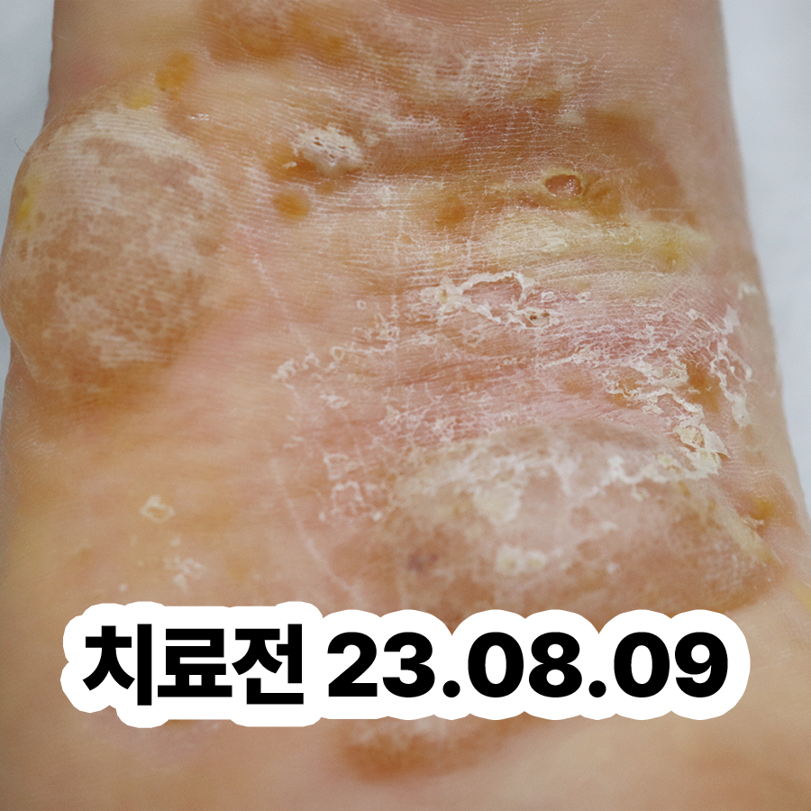 경기광주 발가락 한포진 연고 관련 이미지 2