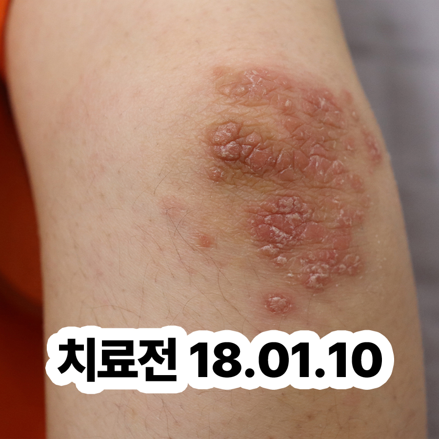분당 건선 피부과 관련 이미지 2