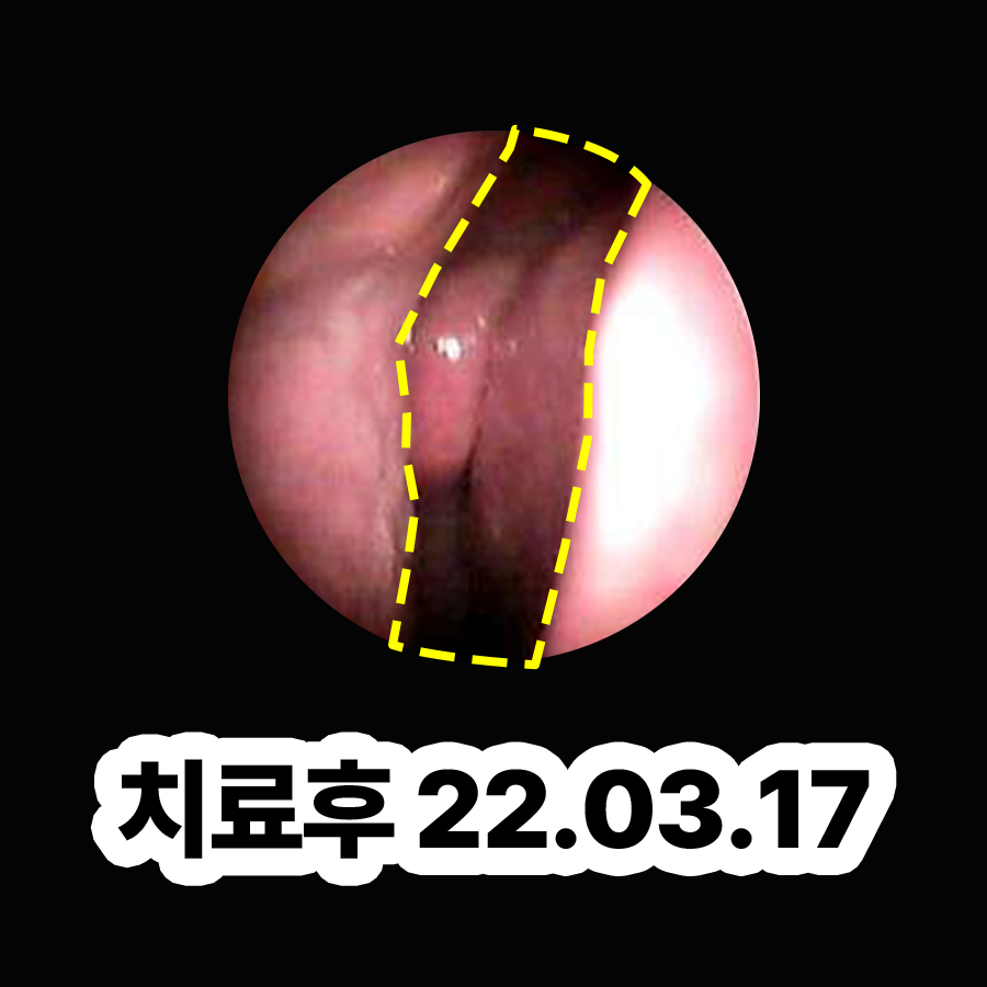 분당 비염 이비인후과 관련 이미지 3