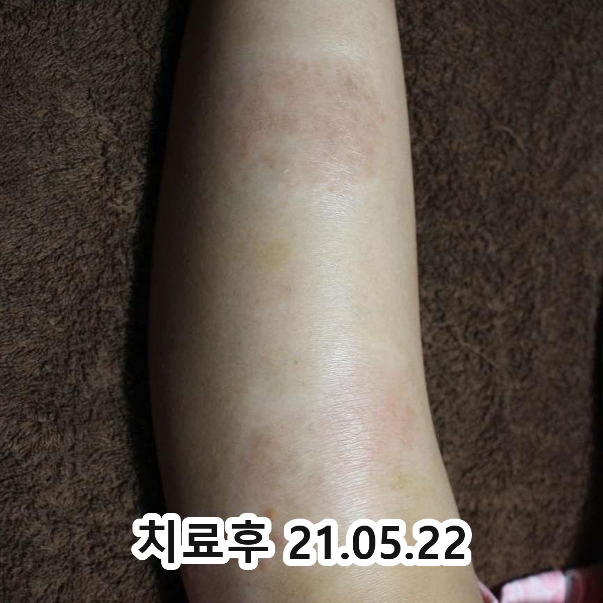 성남 화폐상습진 연고 관련 이미지 3