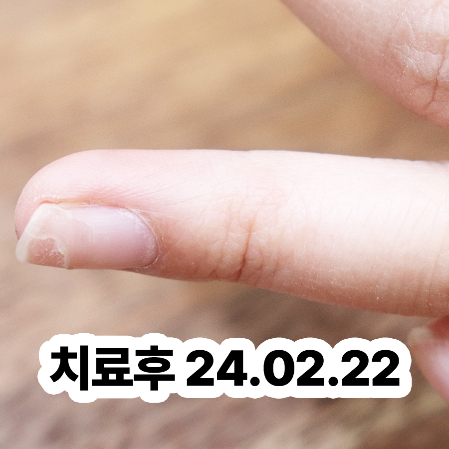 분당 물사마귀피부과 관련 이미지 3