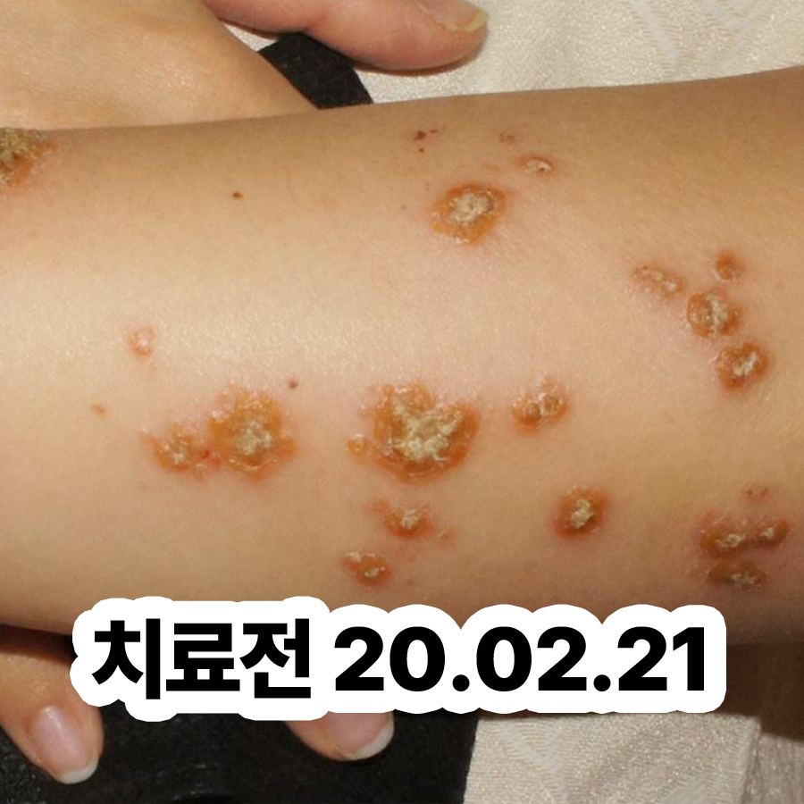 용인 발 습진 치료 병원 관련 이미지 2