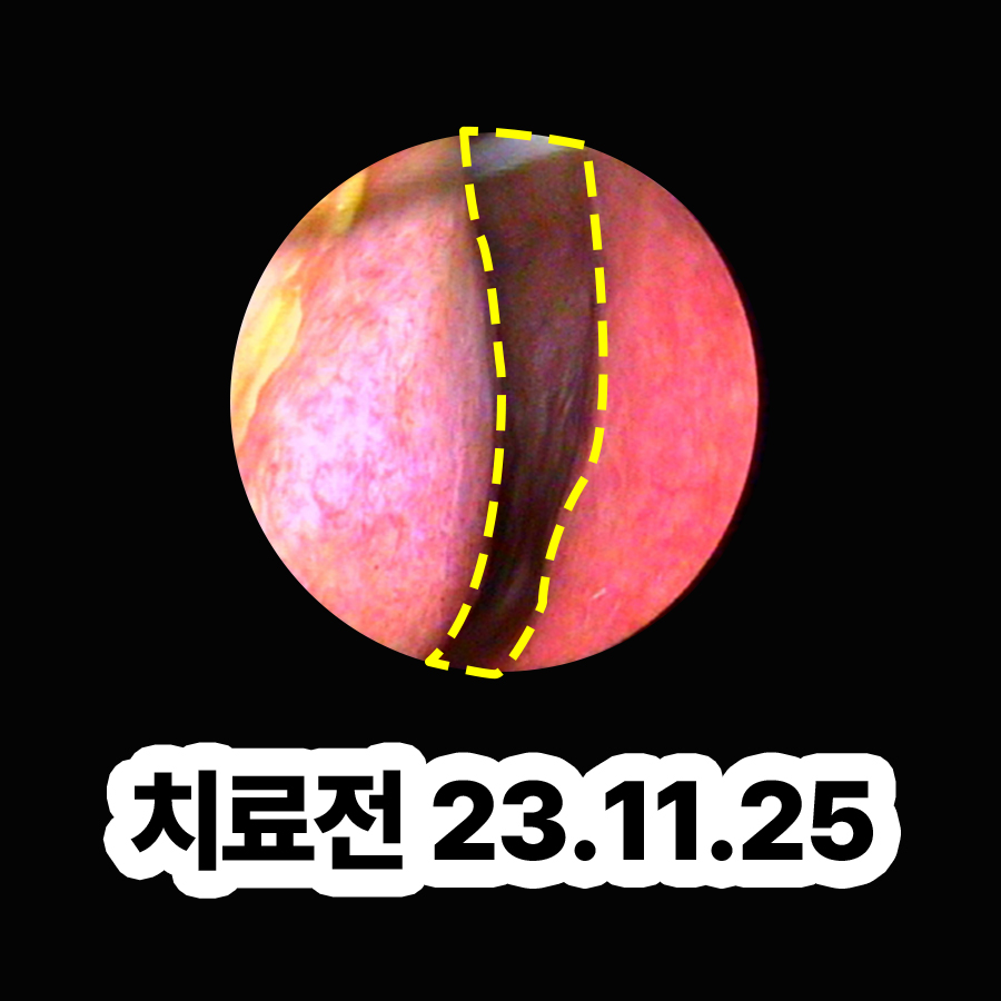 분당 알레르기 비염 치료제 관련 이미지 2