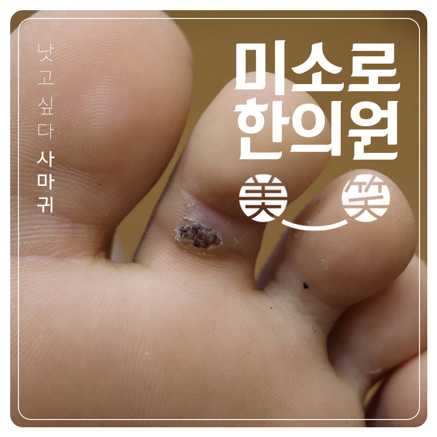 분당 족저사마귀한의원 관련 이미지 1