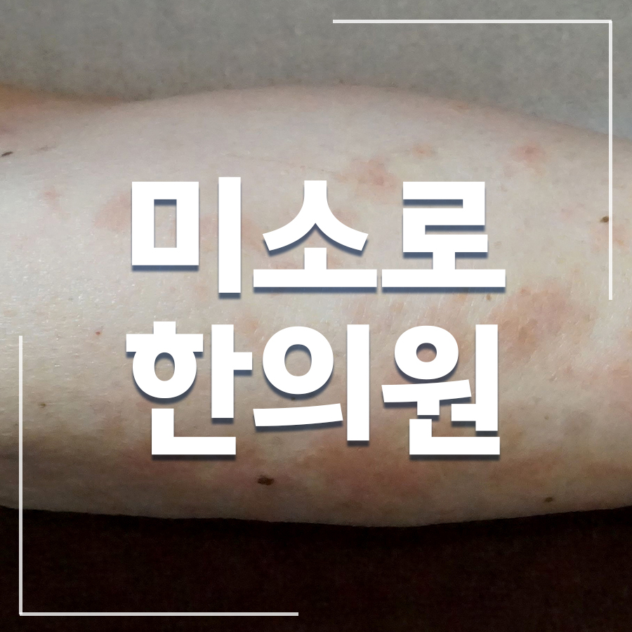 이천 두드러기 치료 잘하는 병원 관련 이미지 1