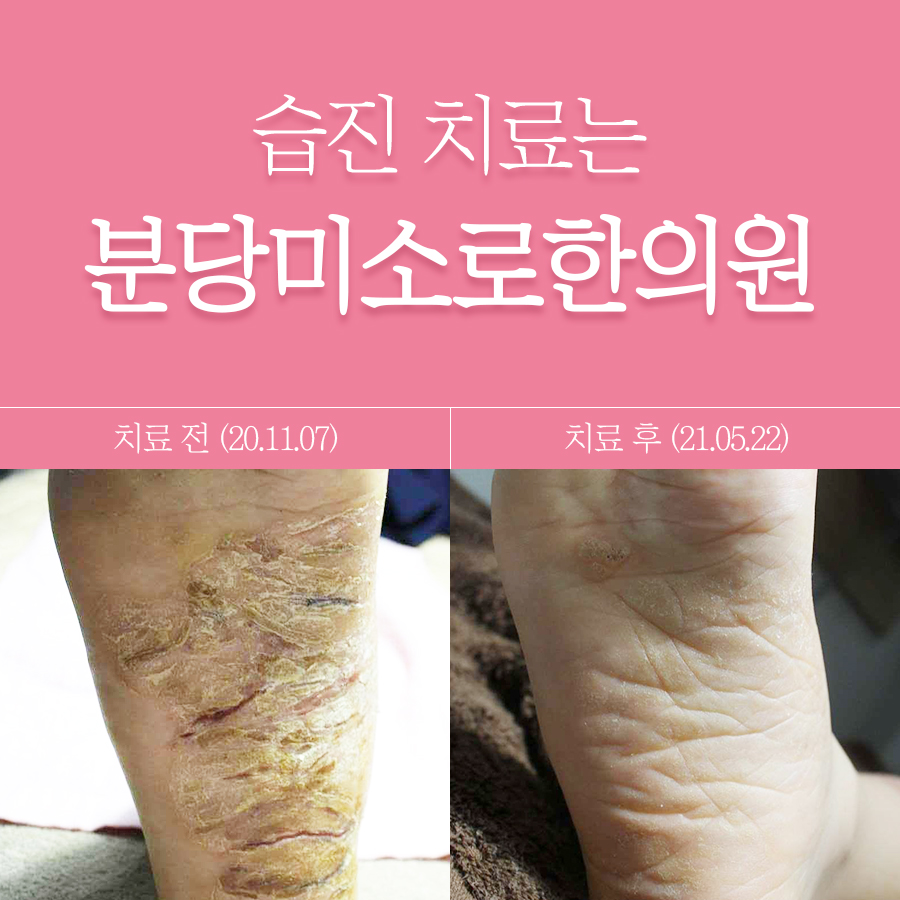 여주 주부습진 가려움 관련 이미지 1