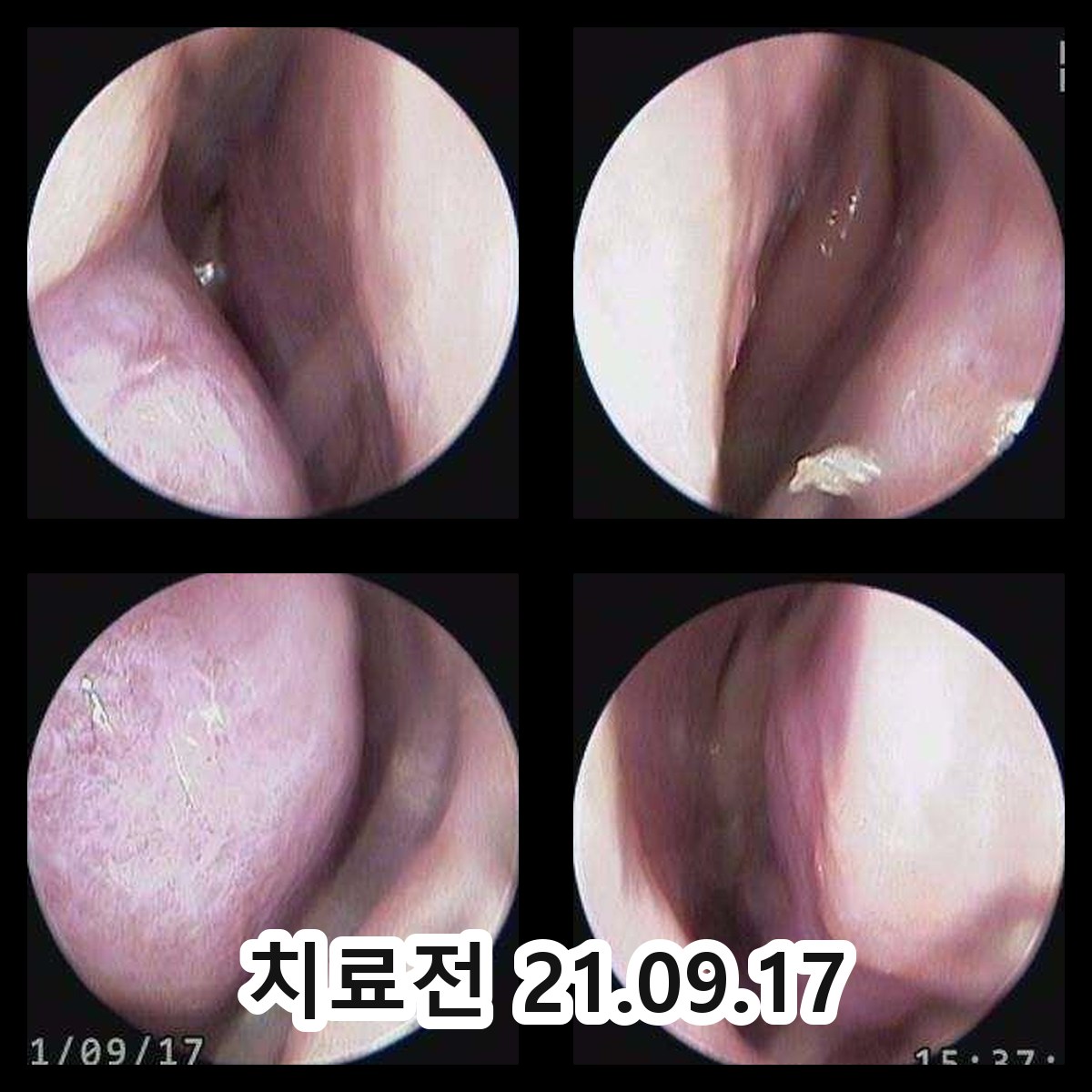 여주 어린이비염한의원 관련 이미지 2