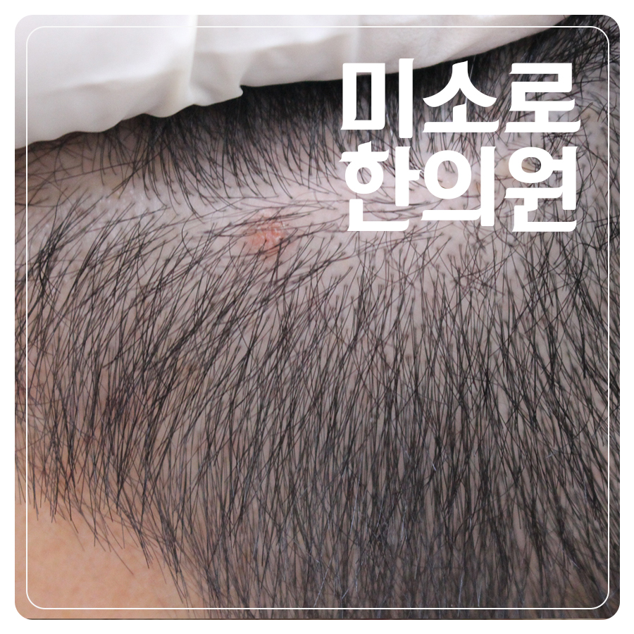 편평사마귀 한약 비용 관련 이미지 1