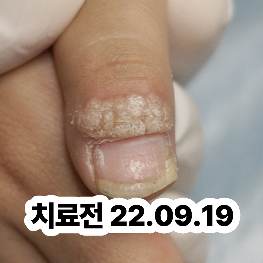 판교 발바닥사마귀치료 후 통증 관련 이미지 2
