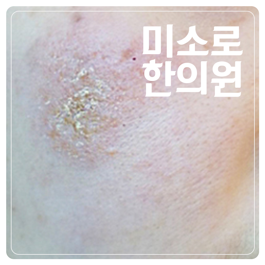 분당 건성 습진 증상 관련 이미지 1