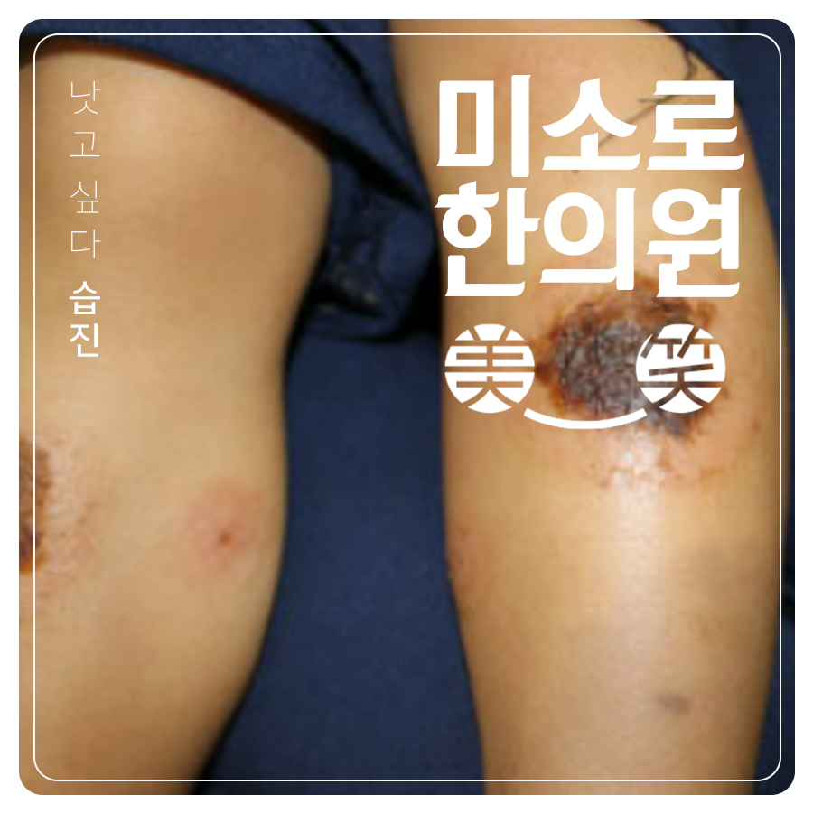 분당 남자 사타구니 습진 치료 관련 이미지 1