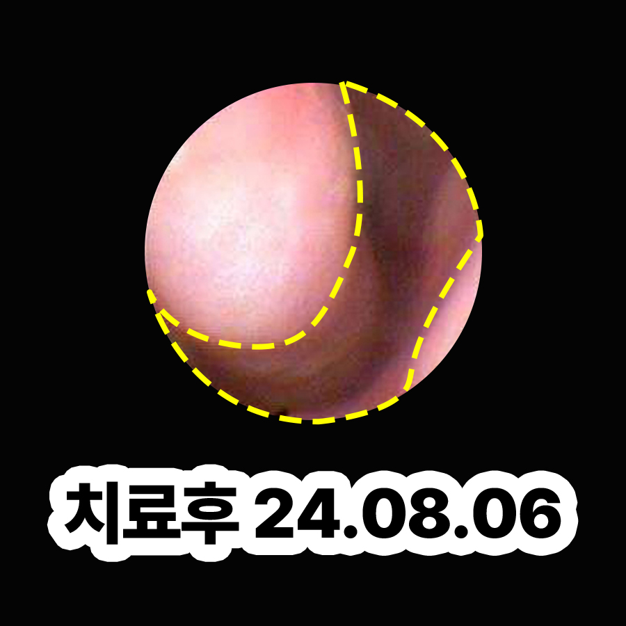 판교 알레르기 비염 치료 비용 관련 이미지 3