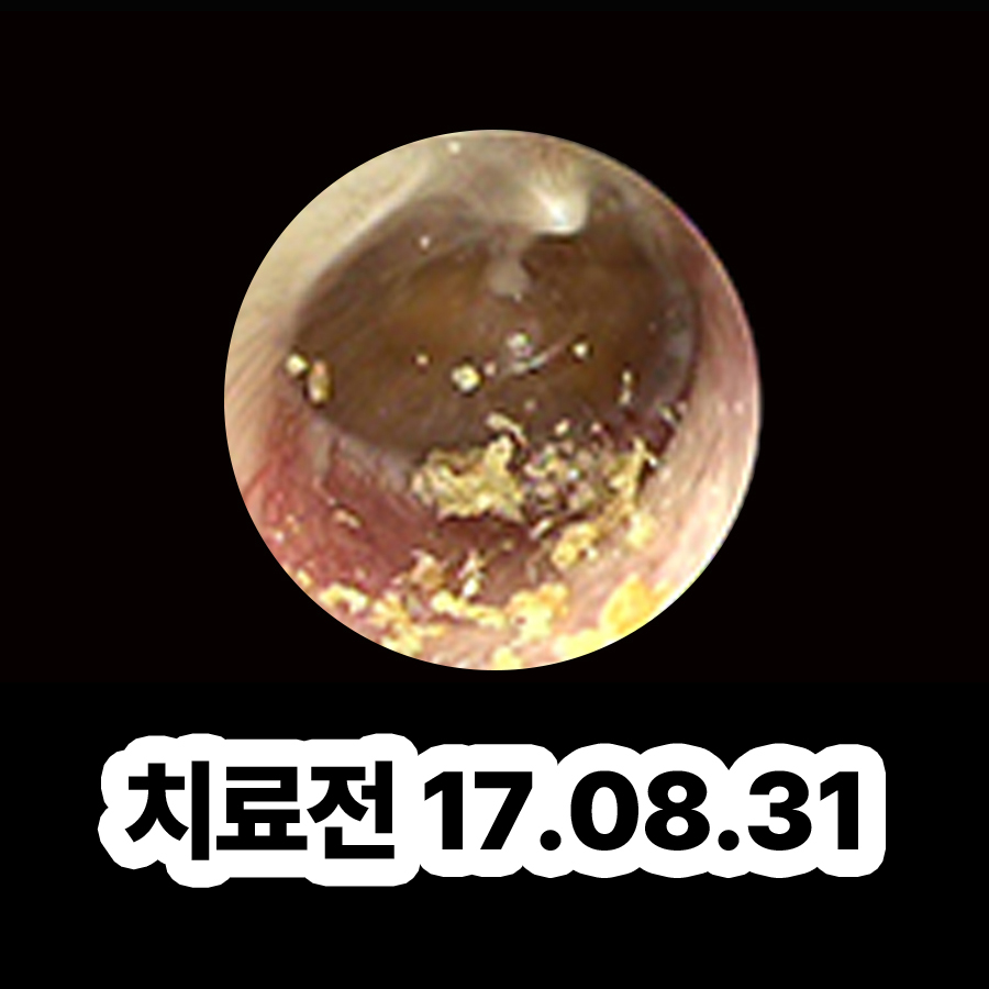 분당 중이염 수술 후유증 관련 이미지 2