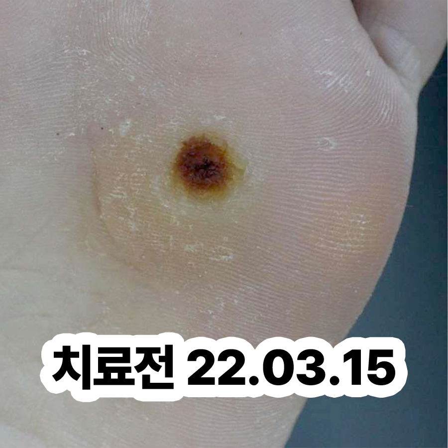분당 편평사마귀 병원 성지 관련 이미지 2