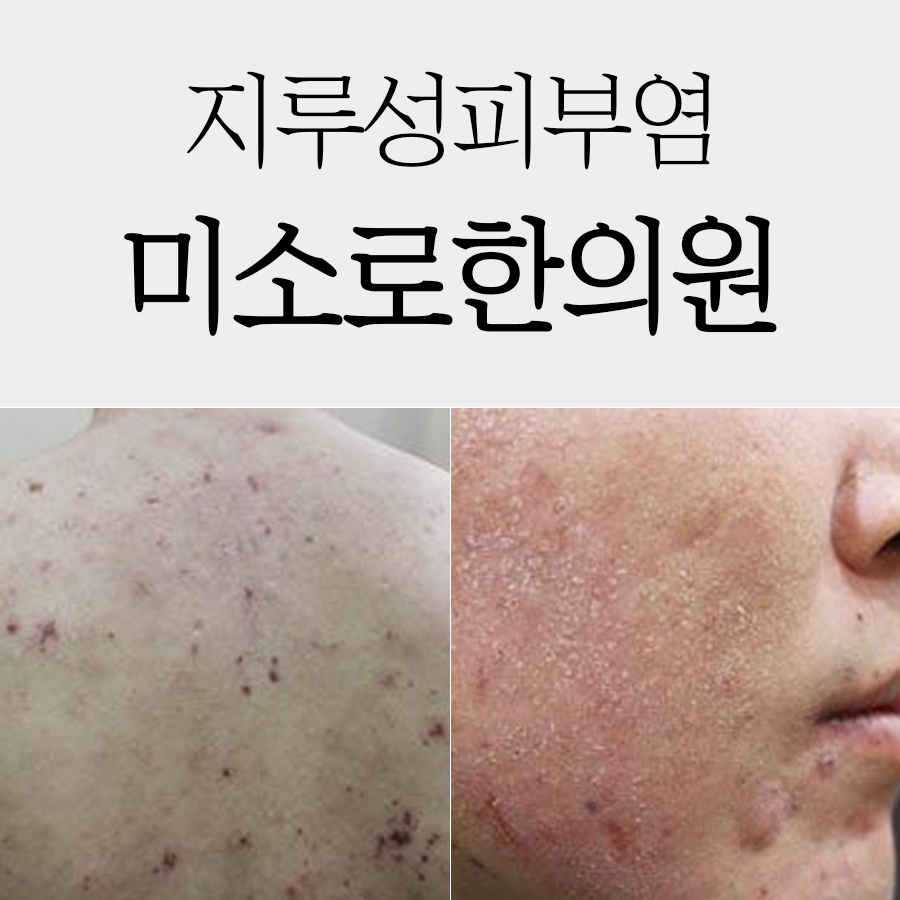 두정동 지루성피부염한의원추천 관련 이미지 1
