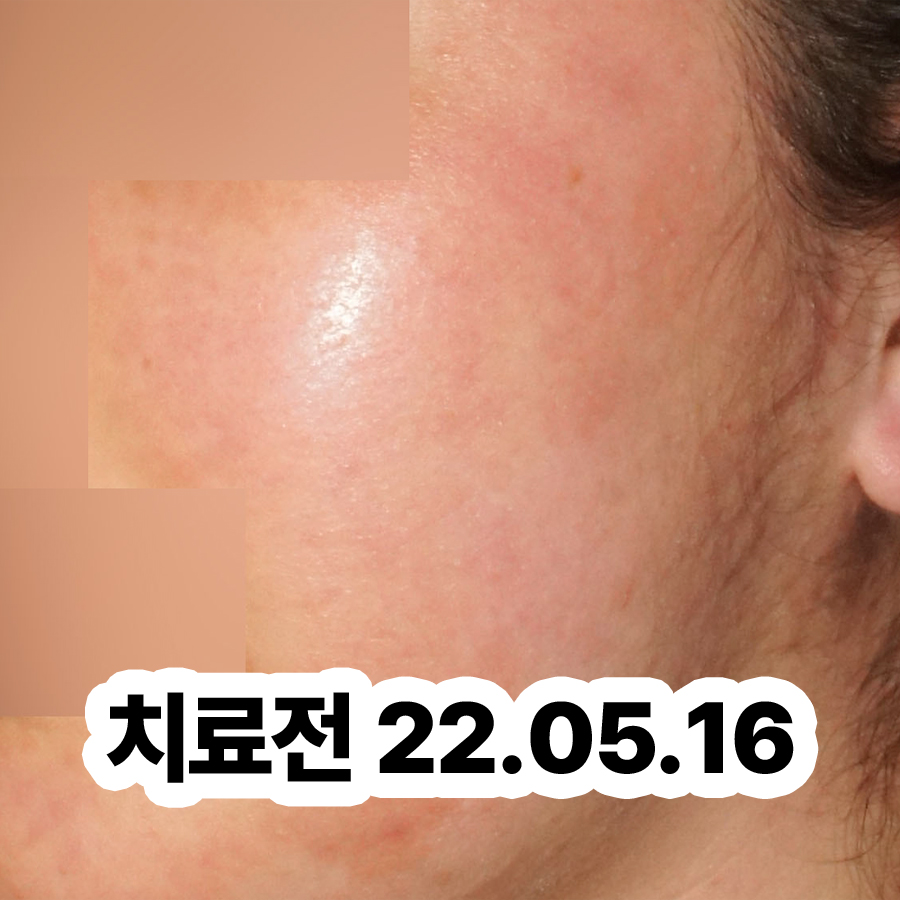 분당 지루성피부염한의원추천 관련 이미지 2
