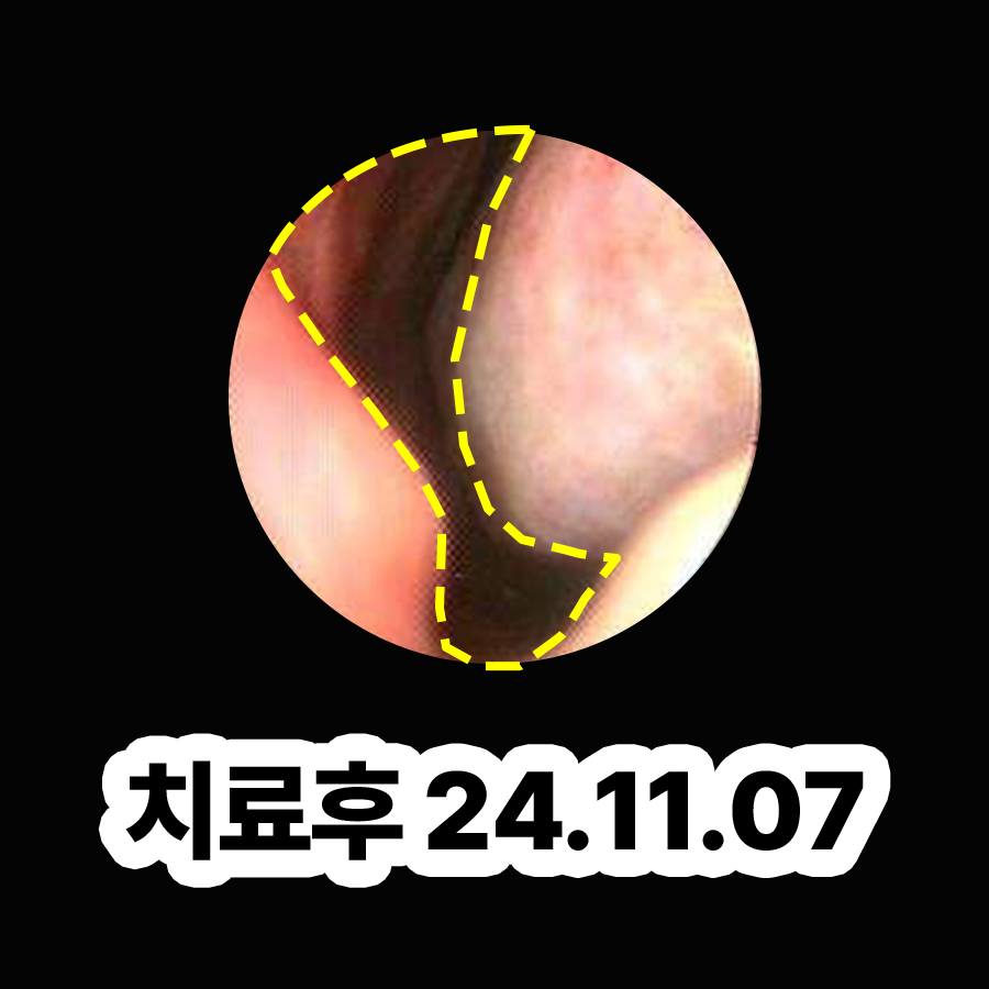 판교 비염콧물빼기 한의원 관련 이미지 3